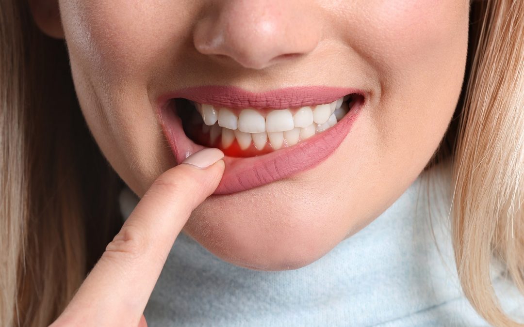 Gingivitis, what is it, and how to avoid it?