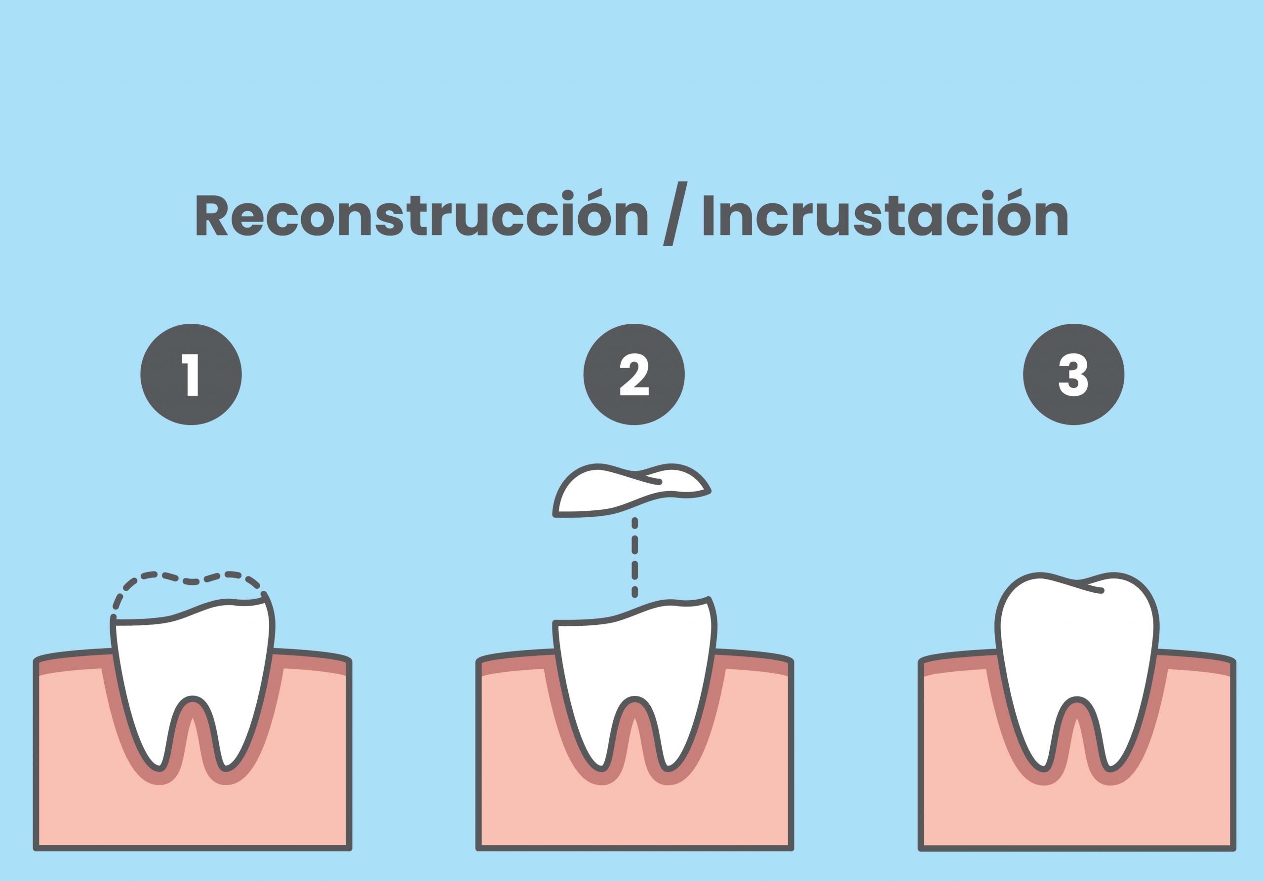 Grafico explicativo sobre reconstrucción e incrustación dental.