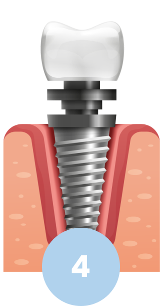 Explanatory diagram of dental implant. Fourth step, crown placement on dental implant...