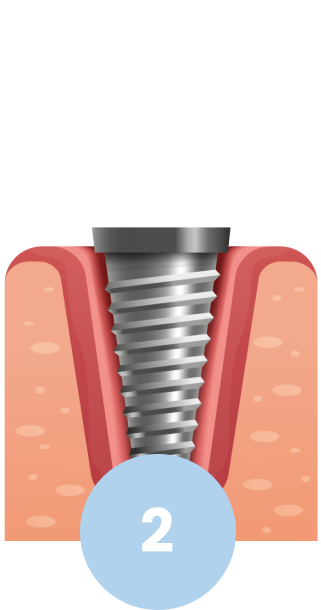 Explanatory diagram of dental implant. Second step, implant placement and gingival integration.