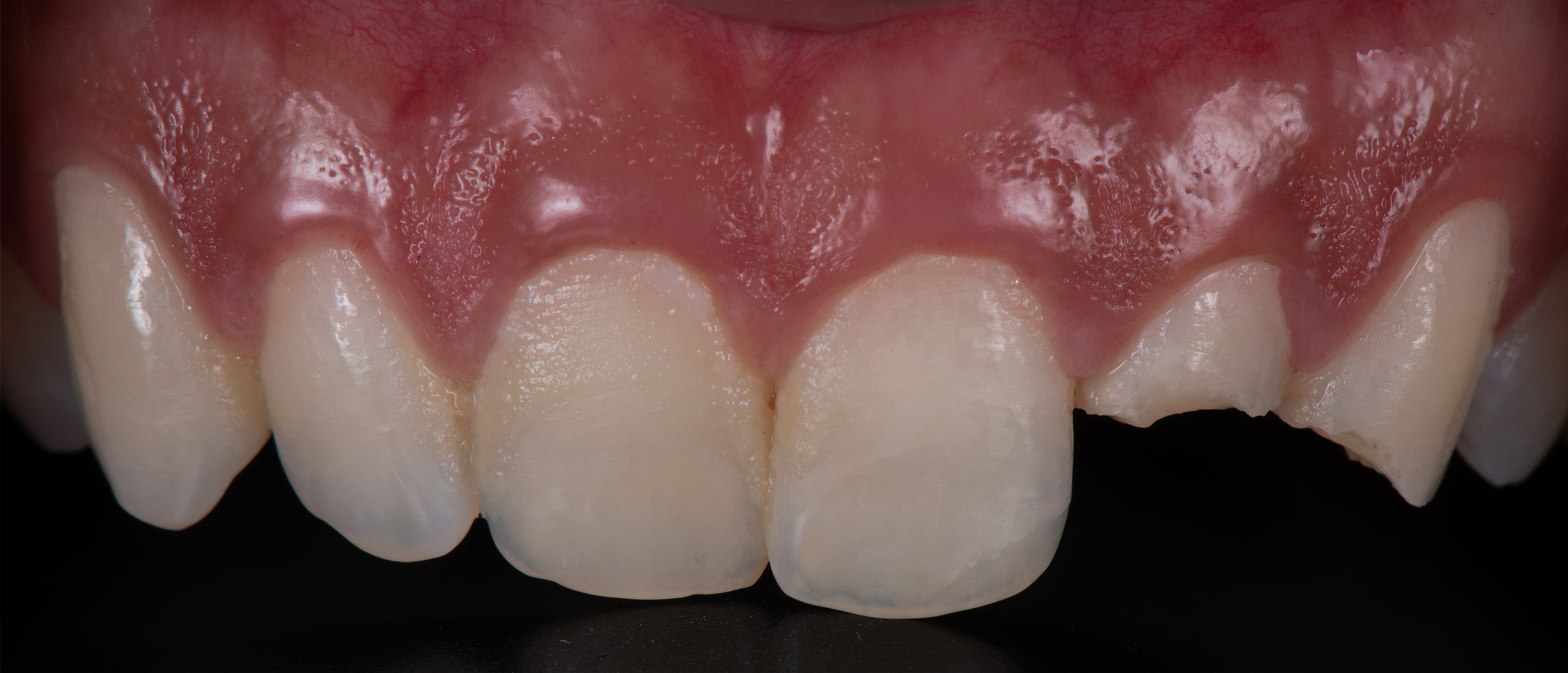 Dentadura de un paciente antes del tratamiento de odontología conservadora.