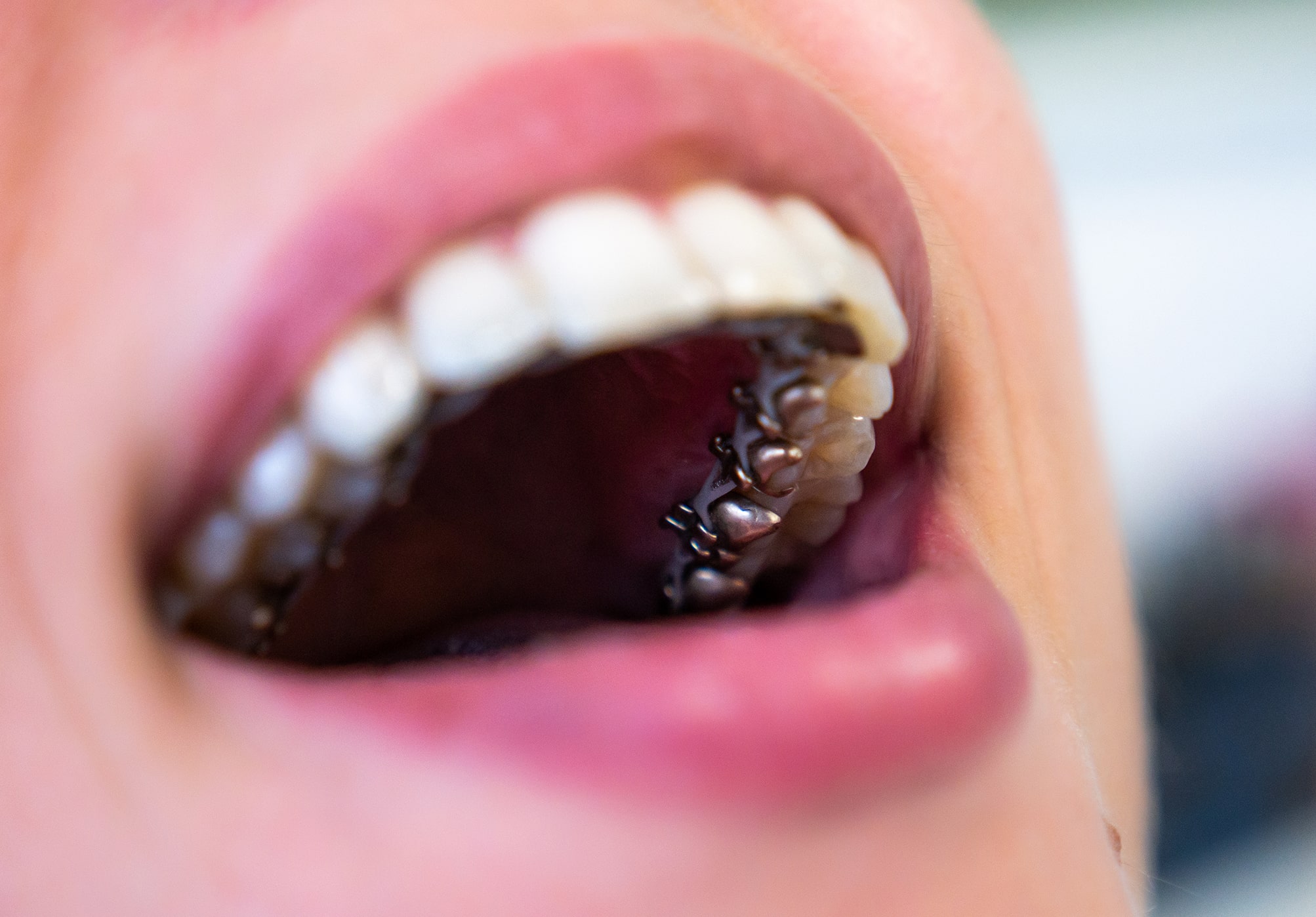 Detail of lingual orthodontics in patient's mouth.