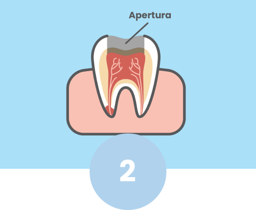 Apertura corona dental para realización de endodoncia.