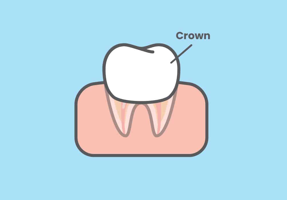 Crown placement to finish endodontics.