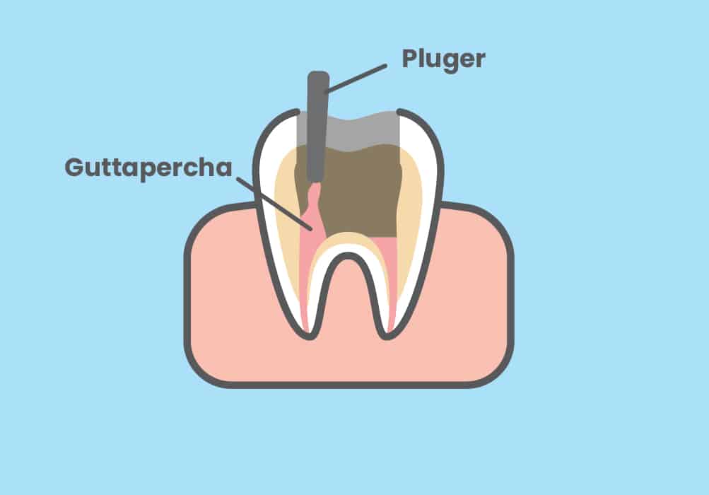 Tooth filling with gutta-percha.
