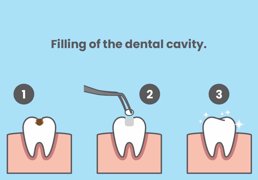Explanatory graphic on the steps to be carried out in the filling of a dental cavity.