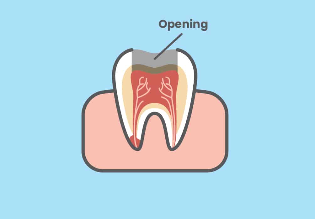 Dental crown opening for endodontic treatment.