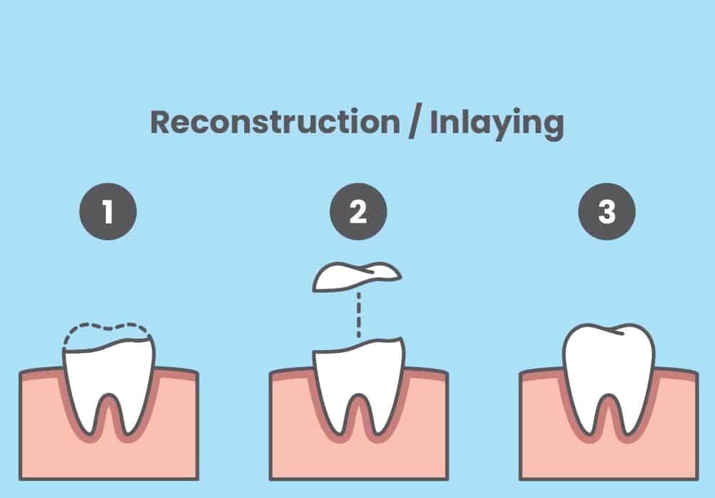 Explanatory graphic on dental reconstruction and inlay.
